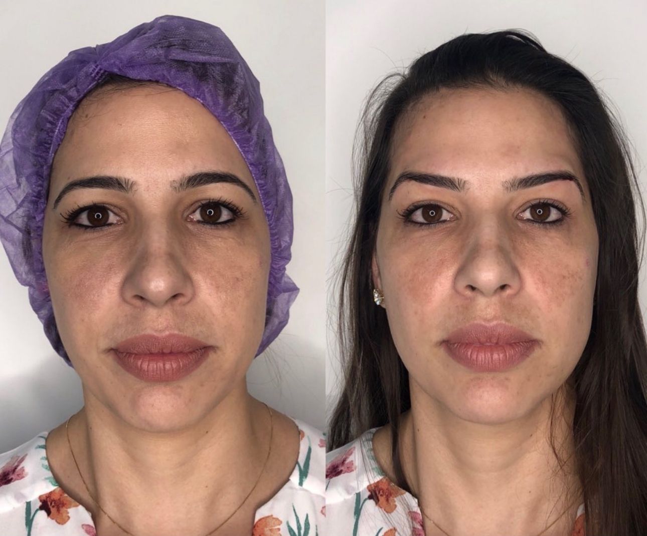 Antes e depois de Castanhares — paciente da Estetic Face Marista